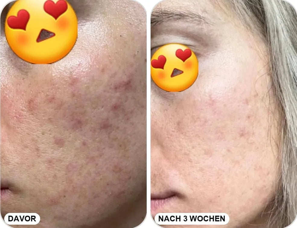 Wange einer Kundin mit roten Pickelmalen, davor und 3 Wochen nach Ankunft der Fade It Creme