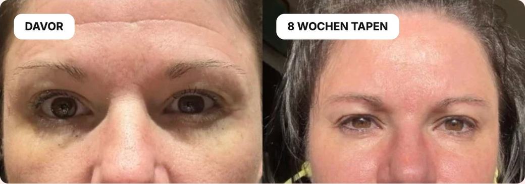 Davor und nach 8 Wochen Tapen, Stirn und Augenpartie