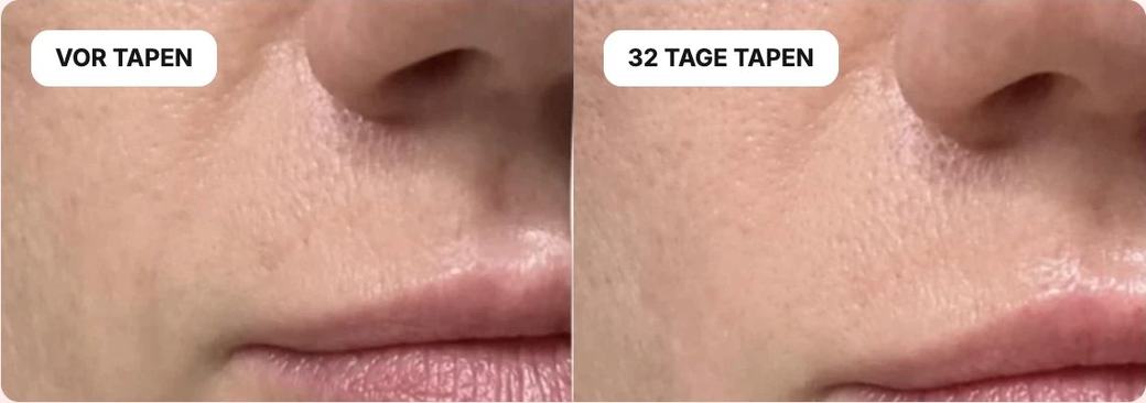 Vor dem Tapen und nach 32 Tagen Tapen, Nasolabialfalte