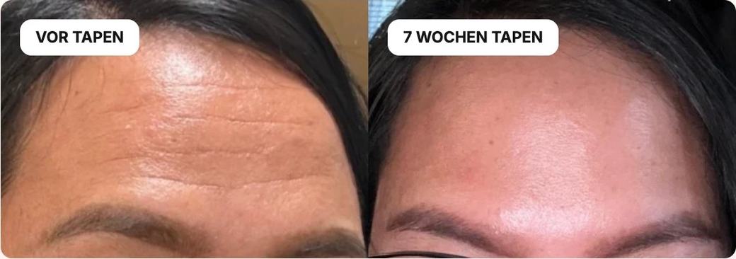 Vor dem Tapen und nach 7 Wochen Tapen, Stirn