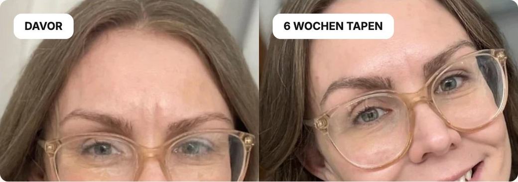 Davor und nach 6 Wochen Tapen, Zornesfalte