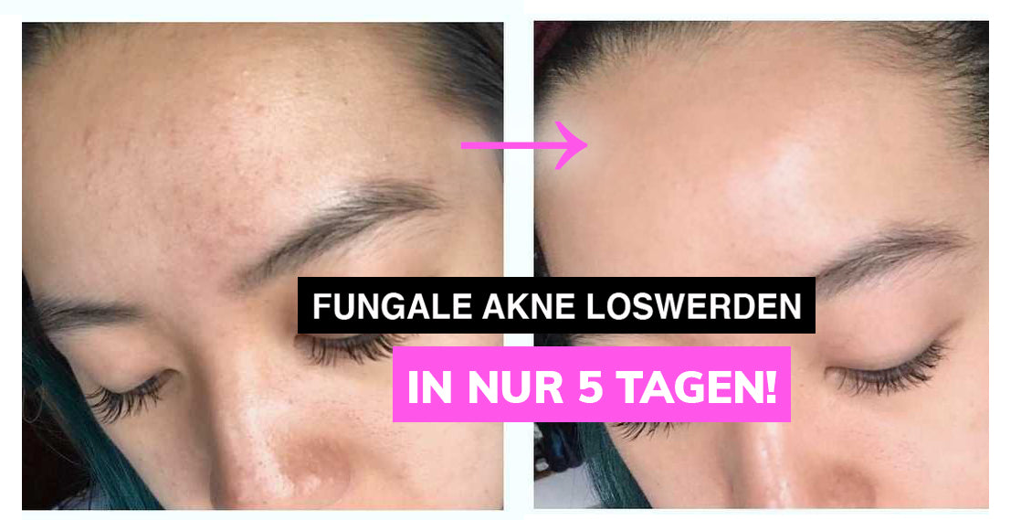 Fungal Akne 