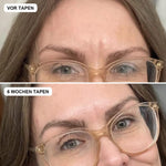 Vorher und nach 6 Wochen Tapen, Zornesfalte