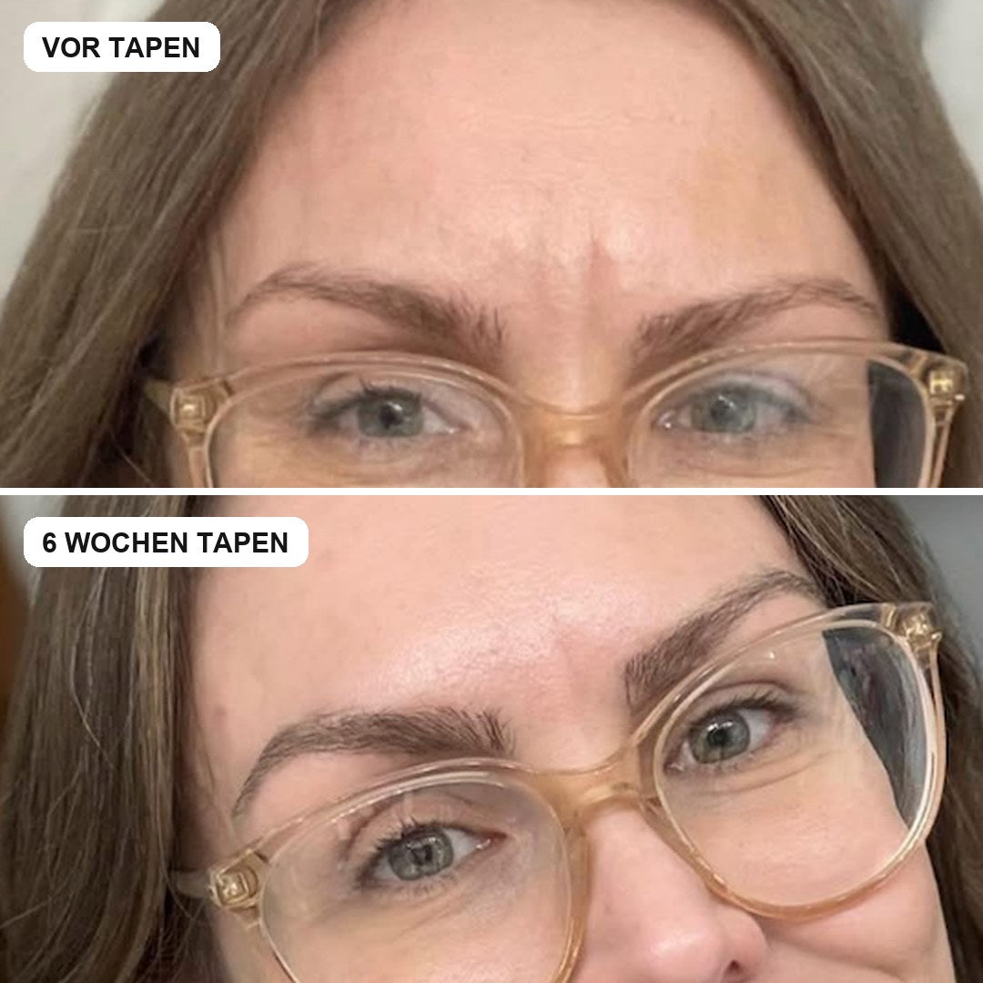 Vorher und nach 6 Wochen Tapen, Zornesfalte