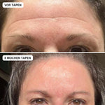 Vorher und nachher mit Face Tapes