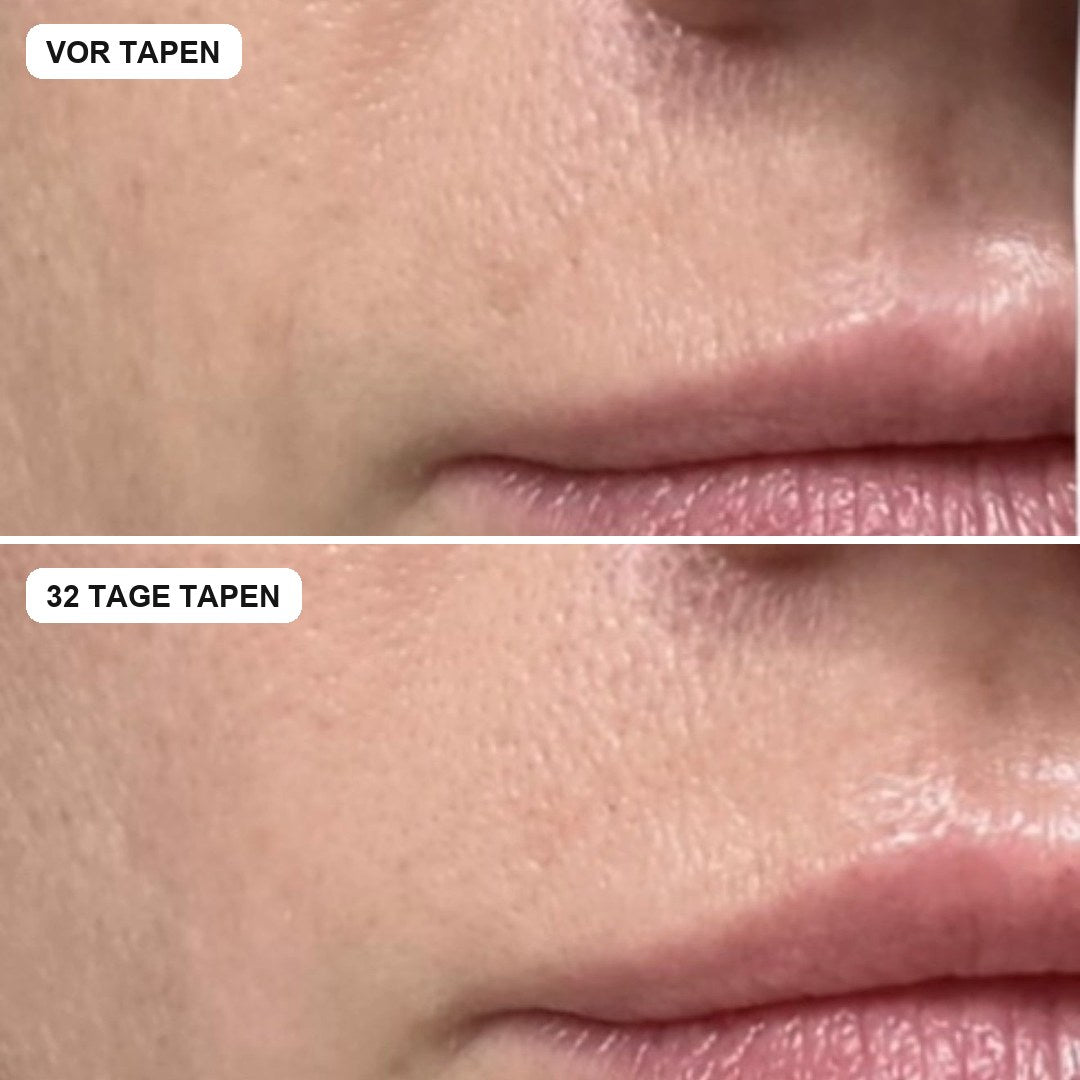 Vorher und nach 32 Tagen Tapen, Nasolabialfalte