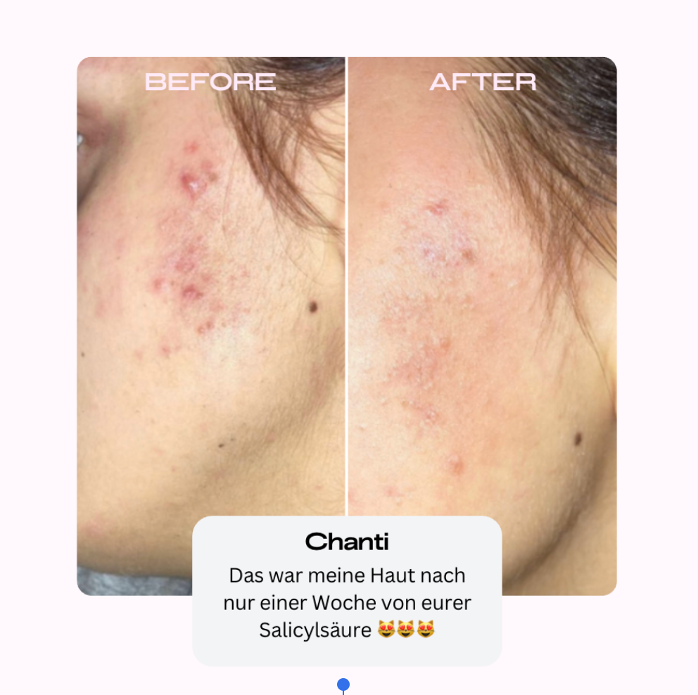 Salicylsäure BHA 2% 50 ml