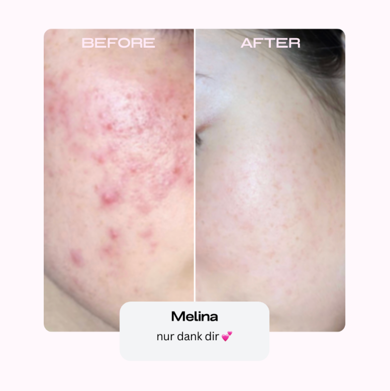 Salicylsäure, Fade It & Sleek Skin Bundle