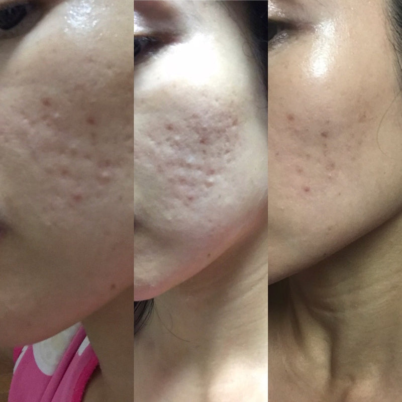 Needling Bestseller Kit
