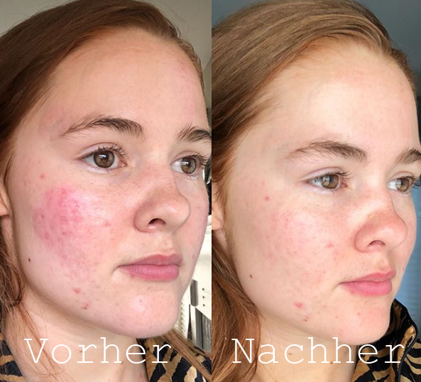 [Beste Hautpflegeprodukte zur Entfernung von Aknenarben und Pickeln]-CANDYCUSH