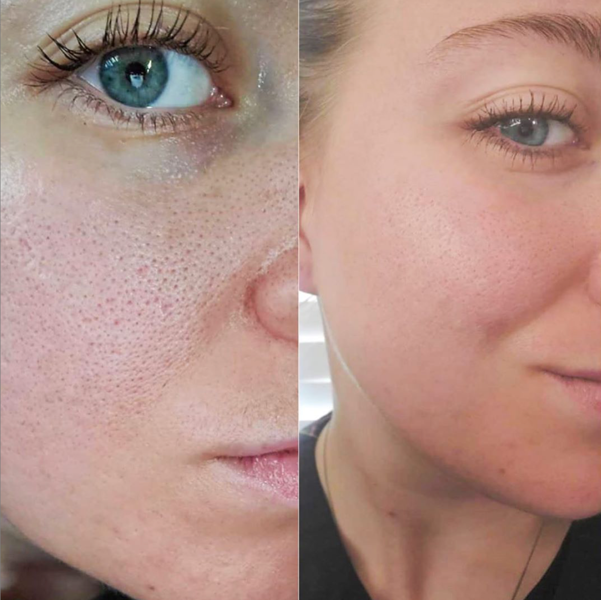 Salicylsäure & Microneedling Set